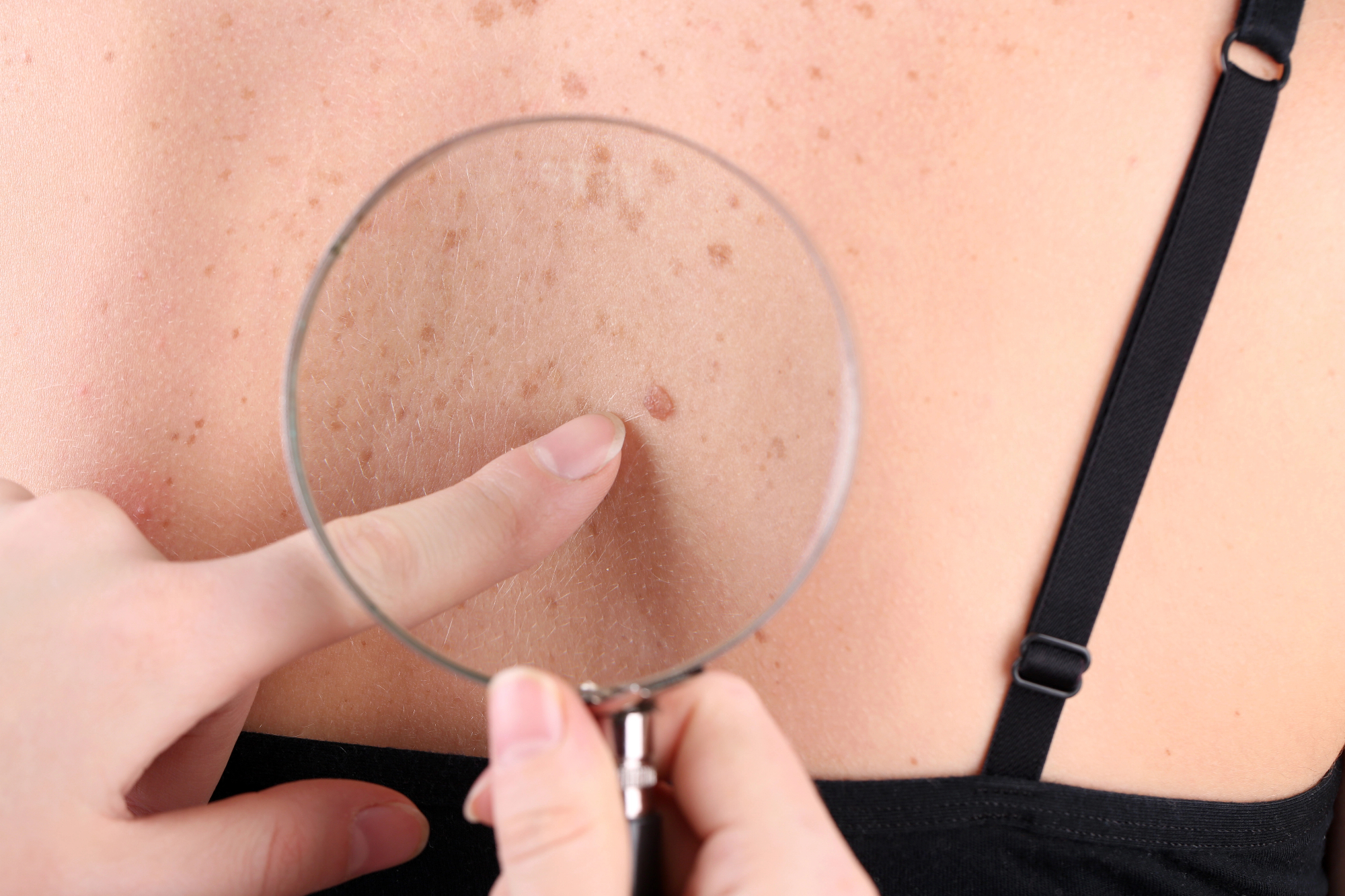 Dermatologija za preventivo in nasvete pri vsakodnevni negi.